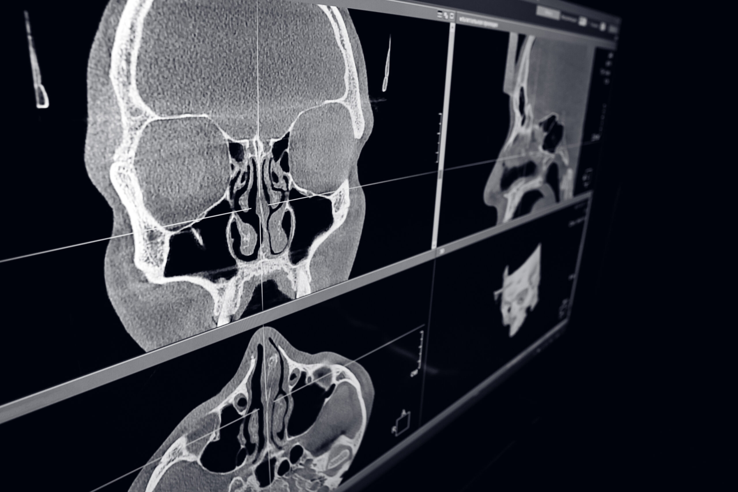 Компьютерная томография ЛОР-органов