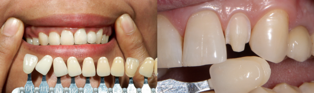 Реставрация зуба цена в томске клиника савиных томск